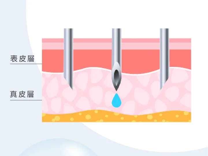 舒適度高:自動感應調整壓力、注射速度，降低痛感