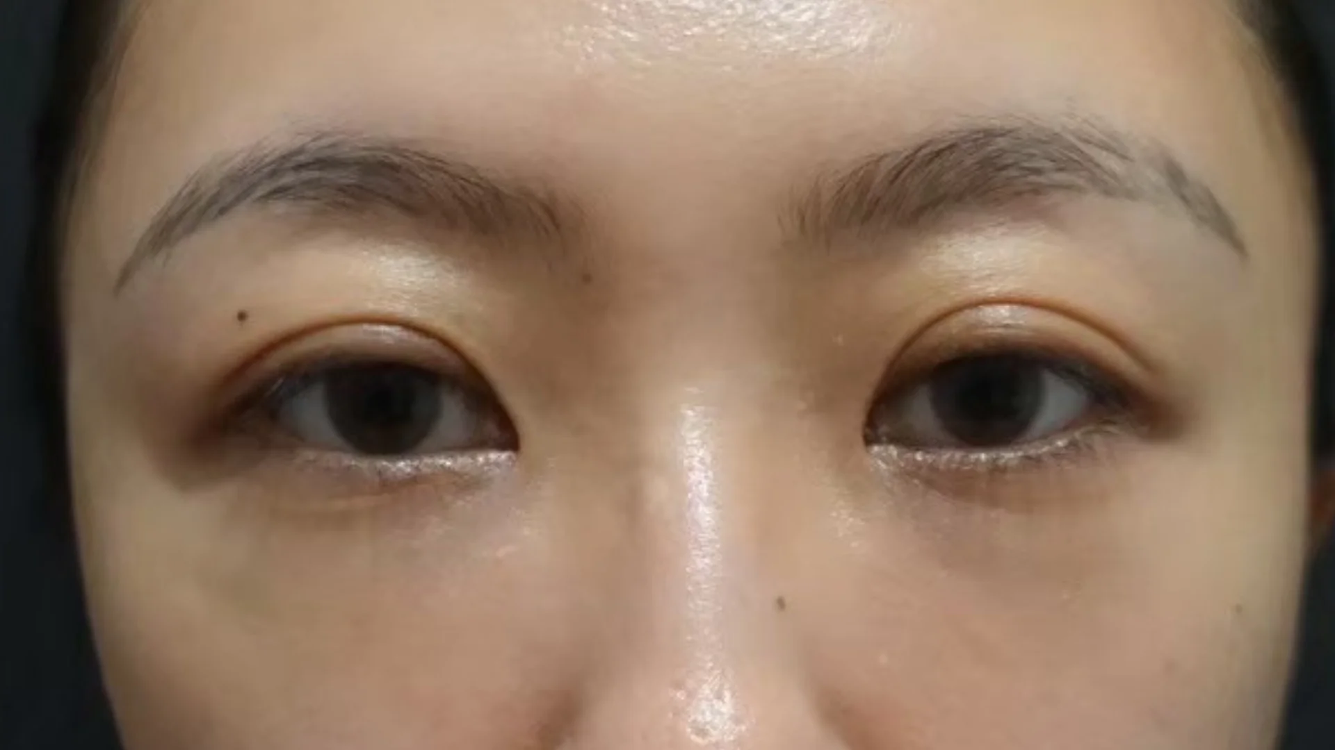 術後