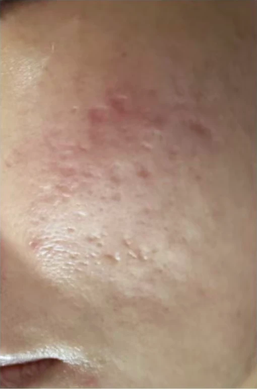 療程前狀態示意