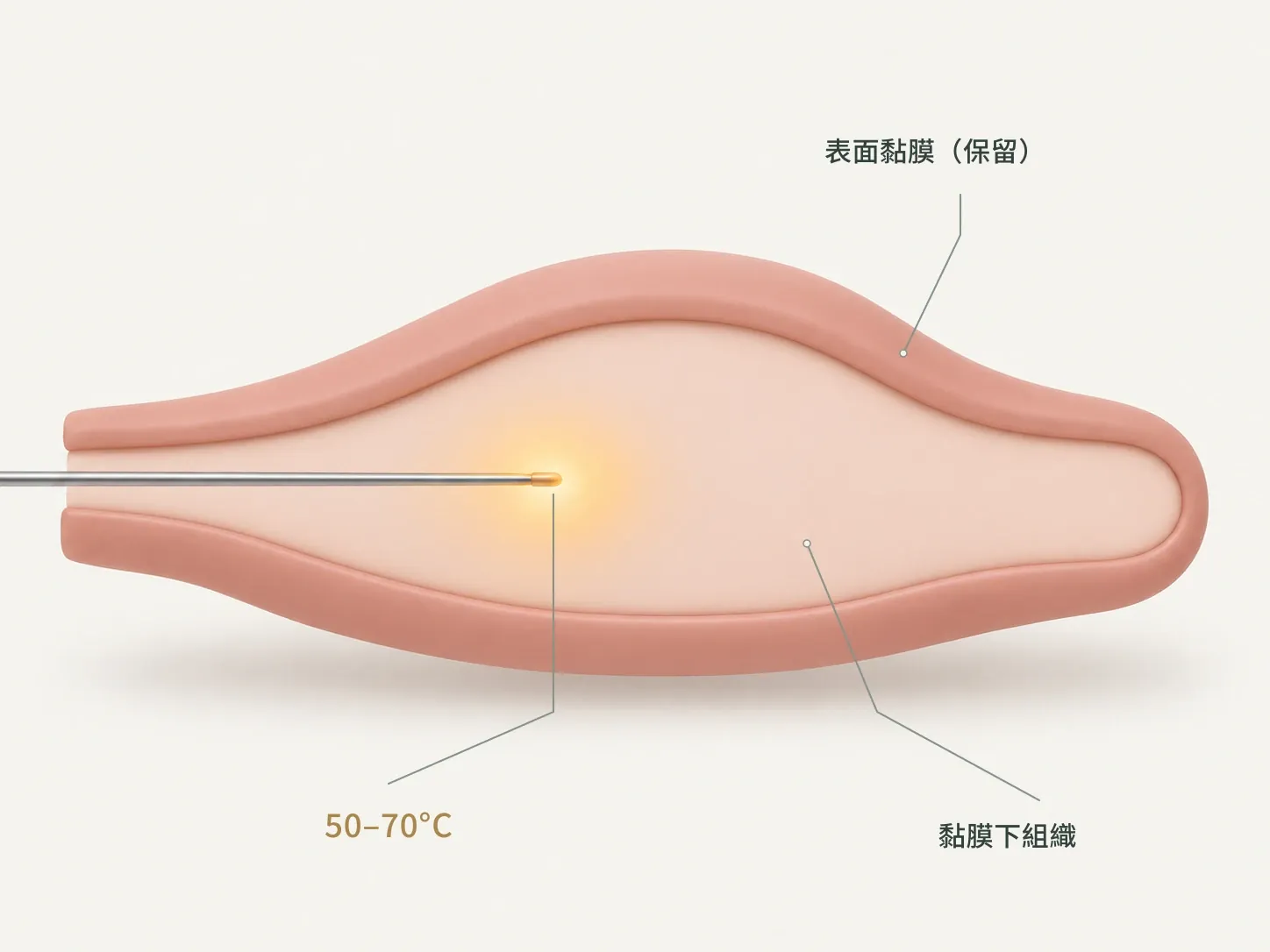 示意圖:細探頭在黏膜下以 50–70°C 溫和加熱,表面黏膜保留