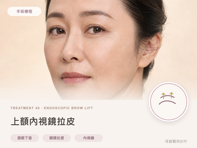 上額內視鏡拉皮｜桃園醫美 琢藝美學診所